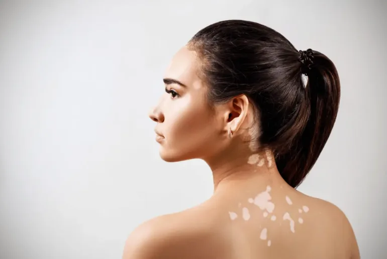 Concealer Cover Vitiligo